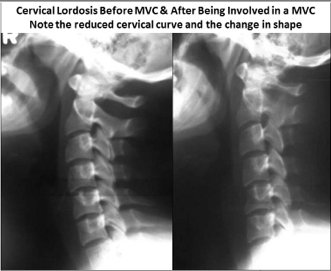 Cervical Lordosis Boise Chiropractor