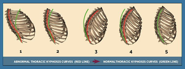 abnormal throracic kyphosis